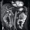 腹部のMRI